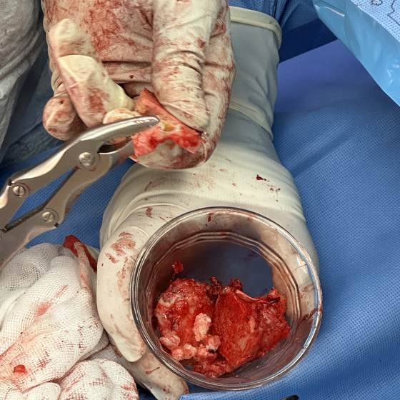 Caso real de artroplastia de cadera 15