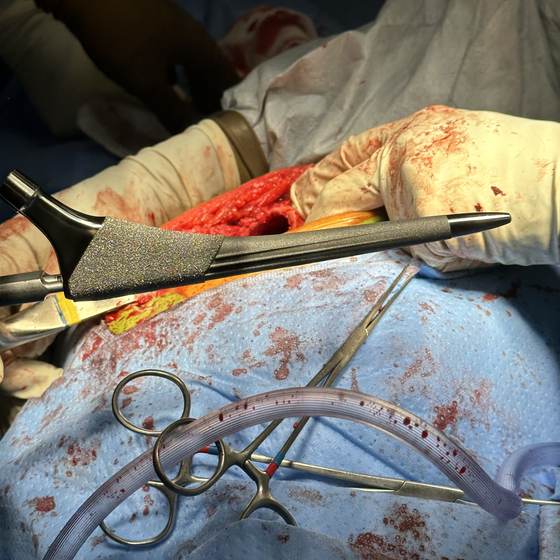 Caso real de artroplastia de cadera 23