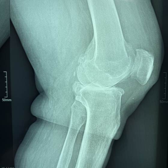 Caso real de artroplastia de rodilla 07