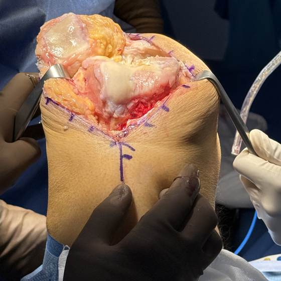 Caso real de artroplastia de rodilla 09