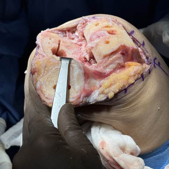 Caso real de artroplastia de rodilla 19