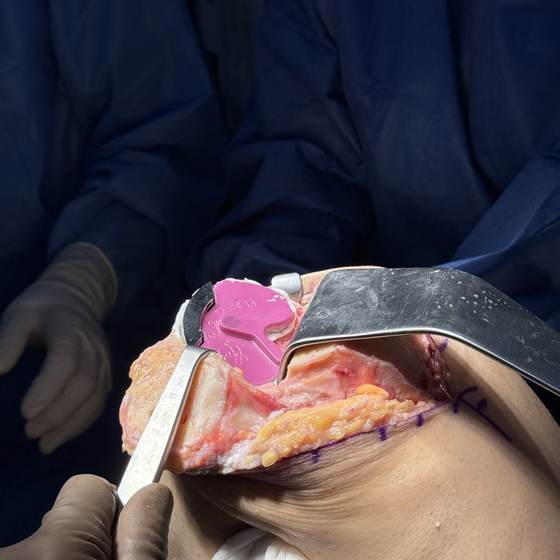 Caso real de artroplastia de rodilla 22