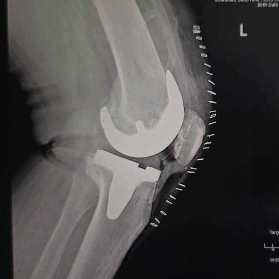 Caso real de artroplastia de rodilla 27
